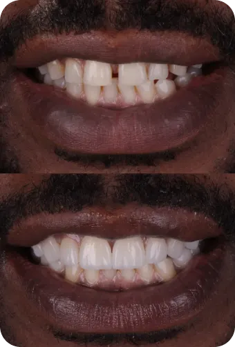 Antes e Depois