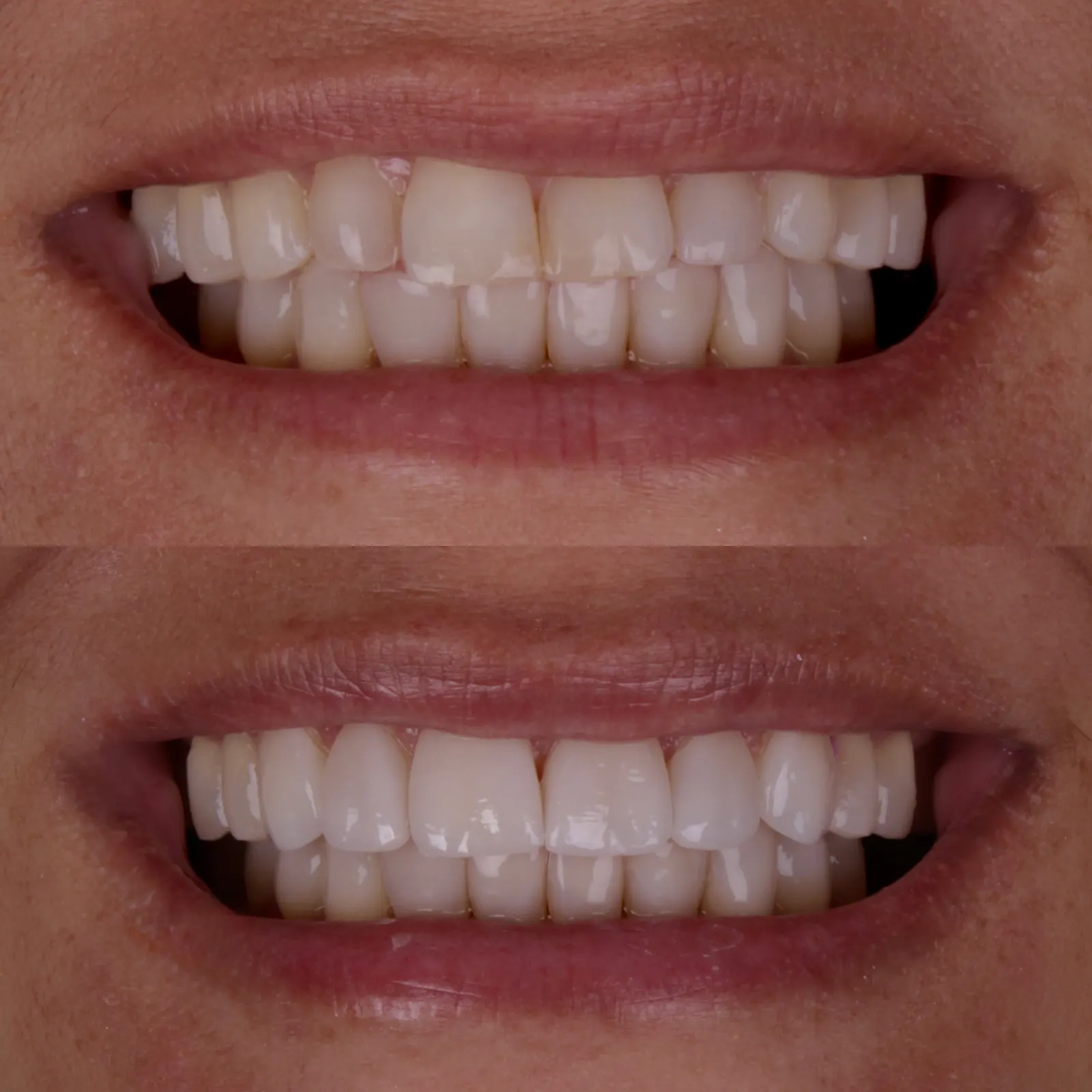 Antes e Depois