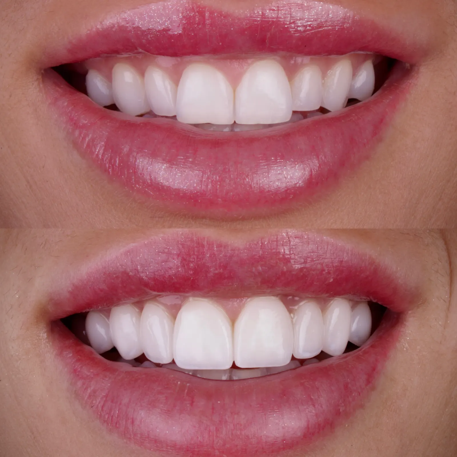 Antes e Depois