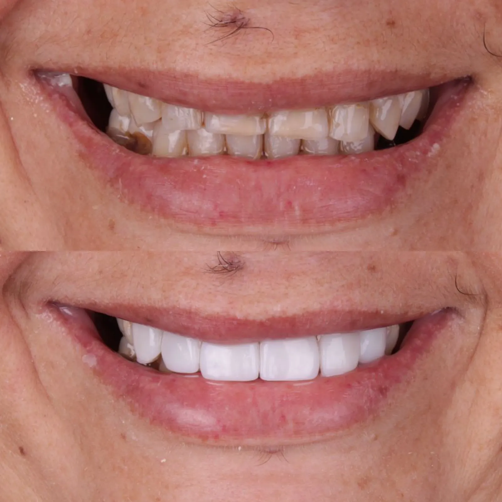 Antes e Depois