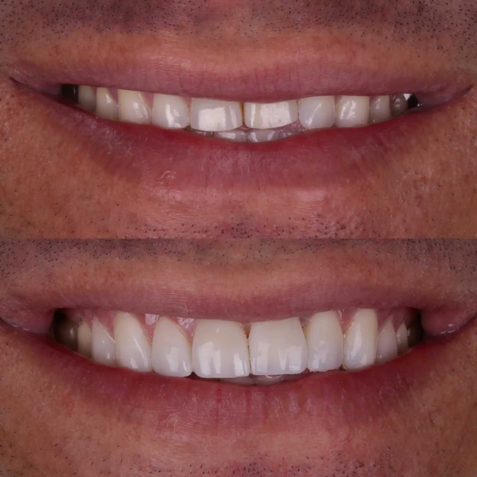 Antes e Depois