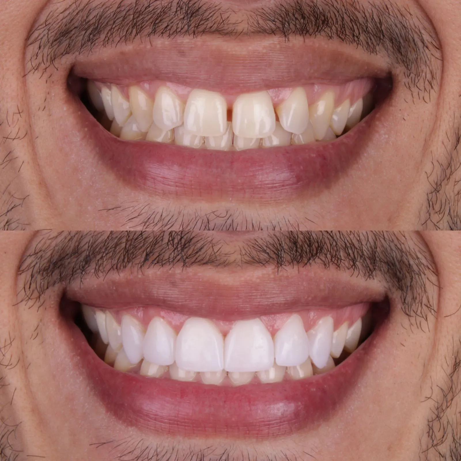 Antes e Depois