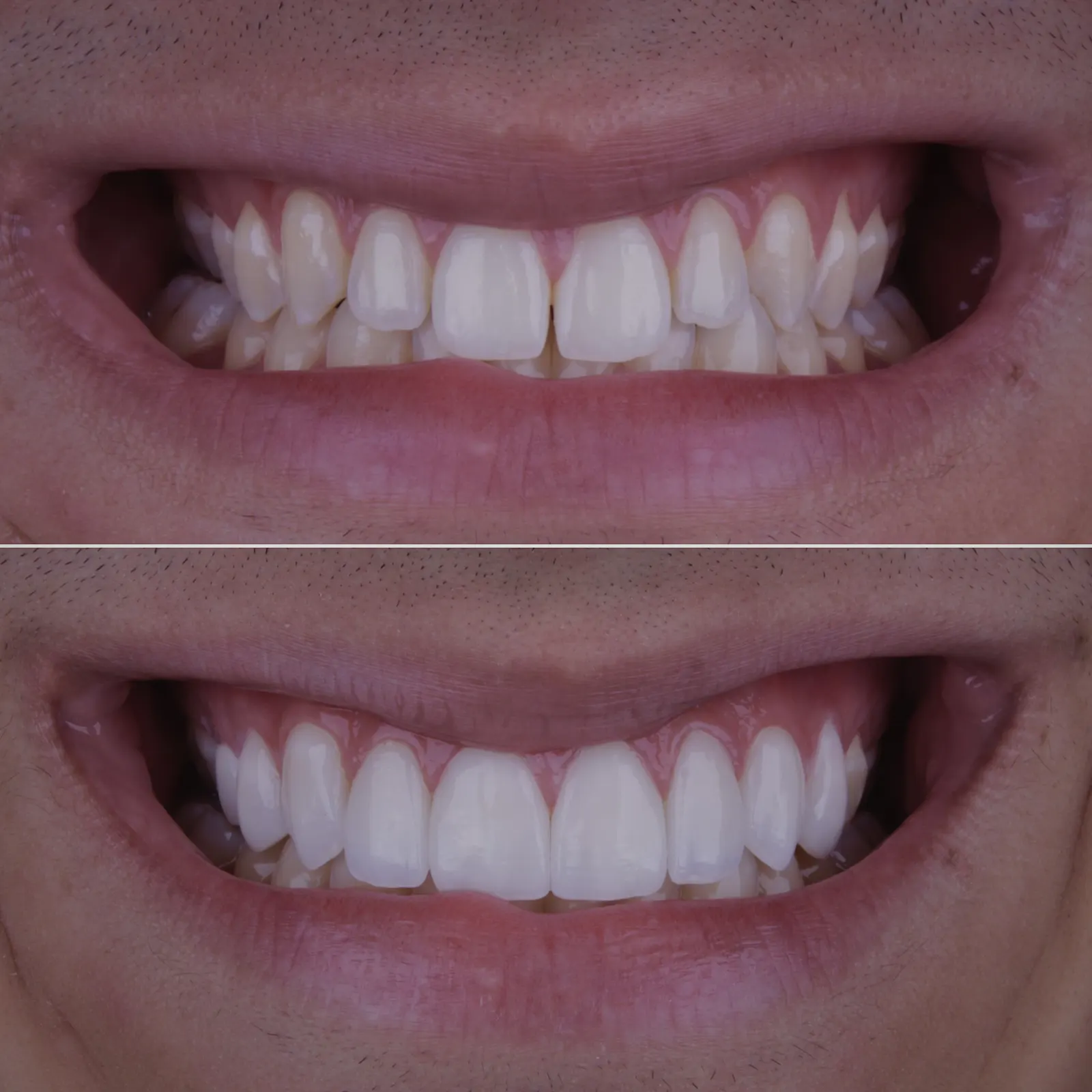 Antes e Depois